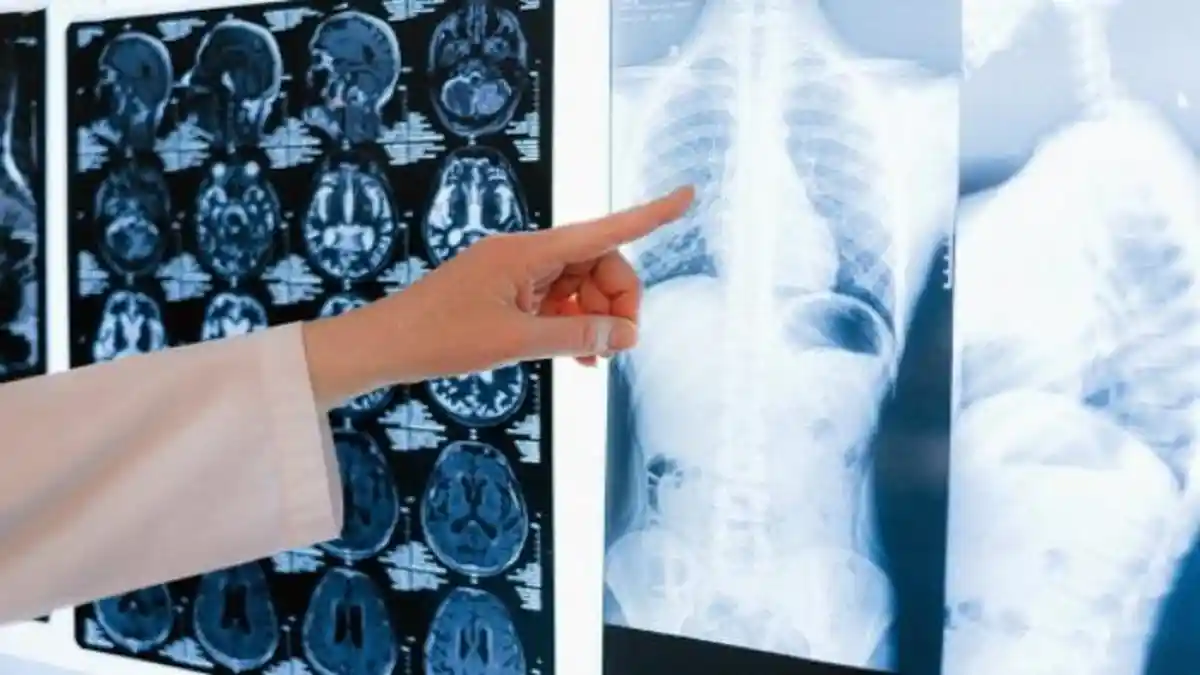 Dokter Luruskan Mitos Tuberkulosis Bisa Menular Lewat Piring atau Gelas
