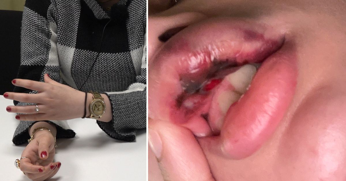 Salong i Eskilstuna pekas ut – fortsätter med fillers trots förbud från Ivo: ”Värsta dagen i mitt liv”
