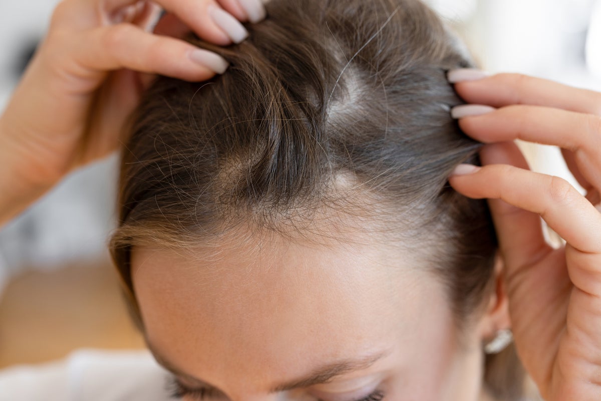 Judge rules that baldness is a disability in tax row with wig makers