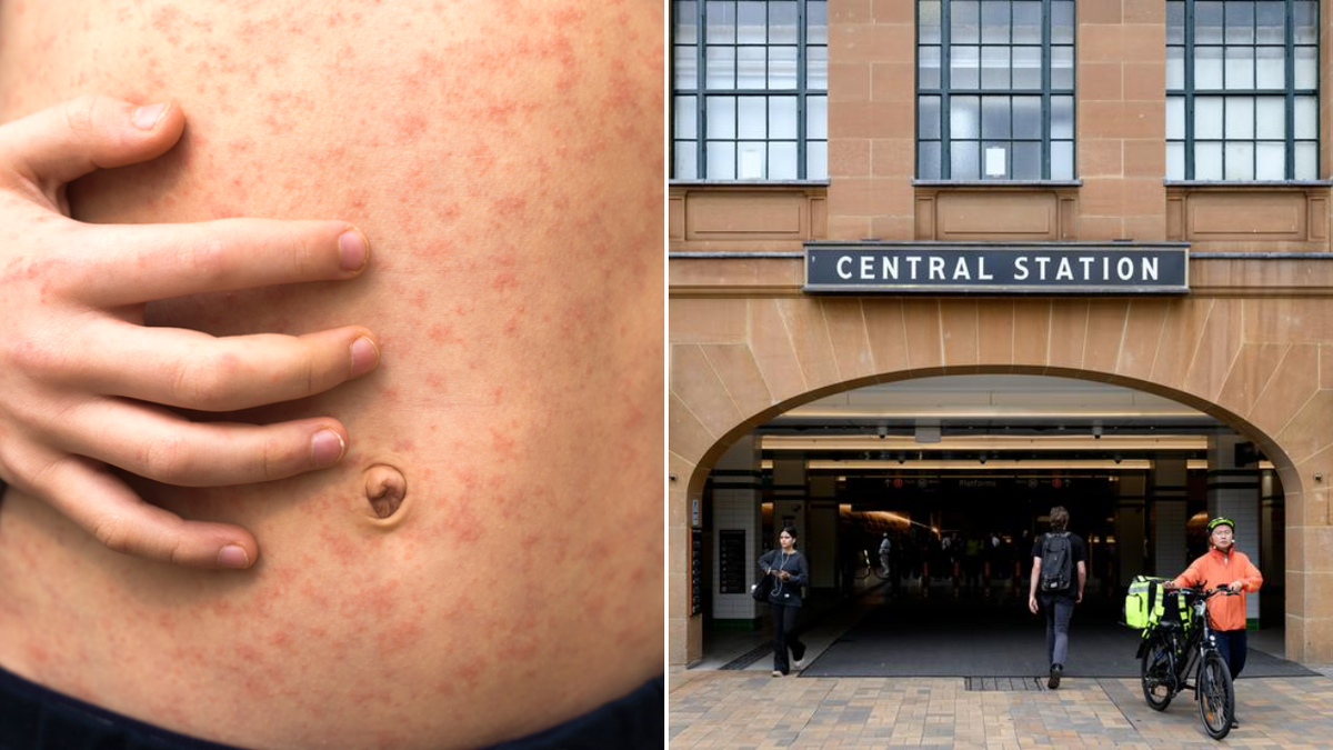 Intensified measles alert in Sydney as travellers return from overseas holidays