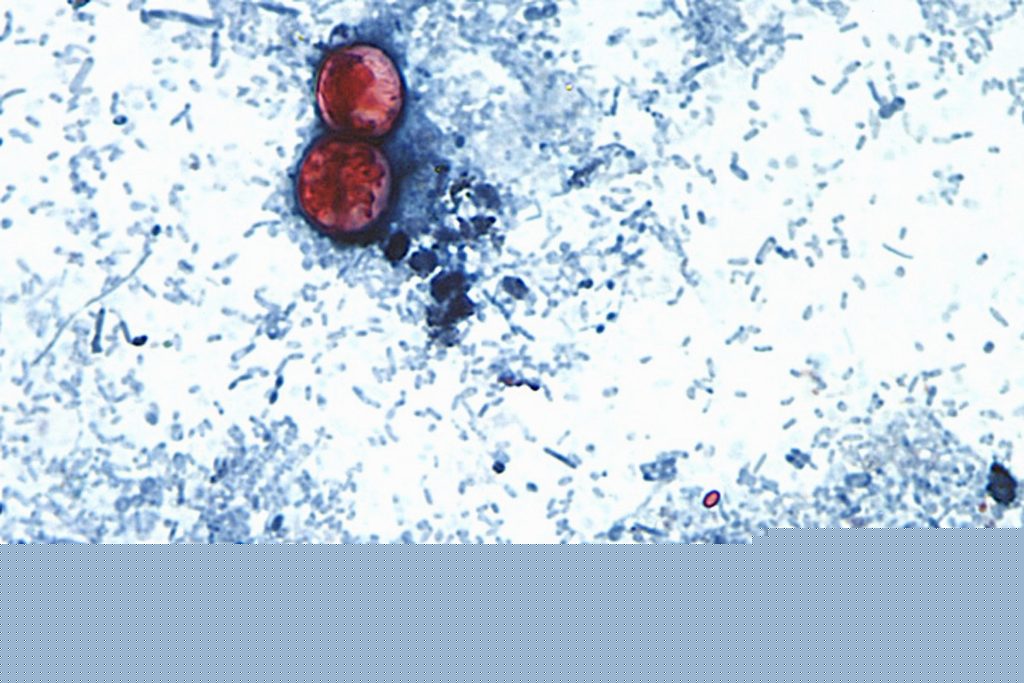 15 states linked to iceberg lettuce cyclospora outbreak