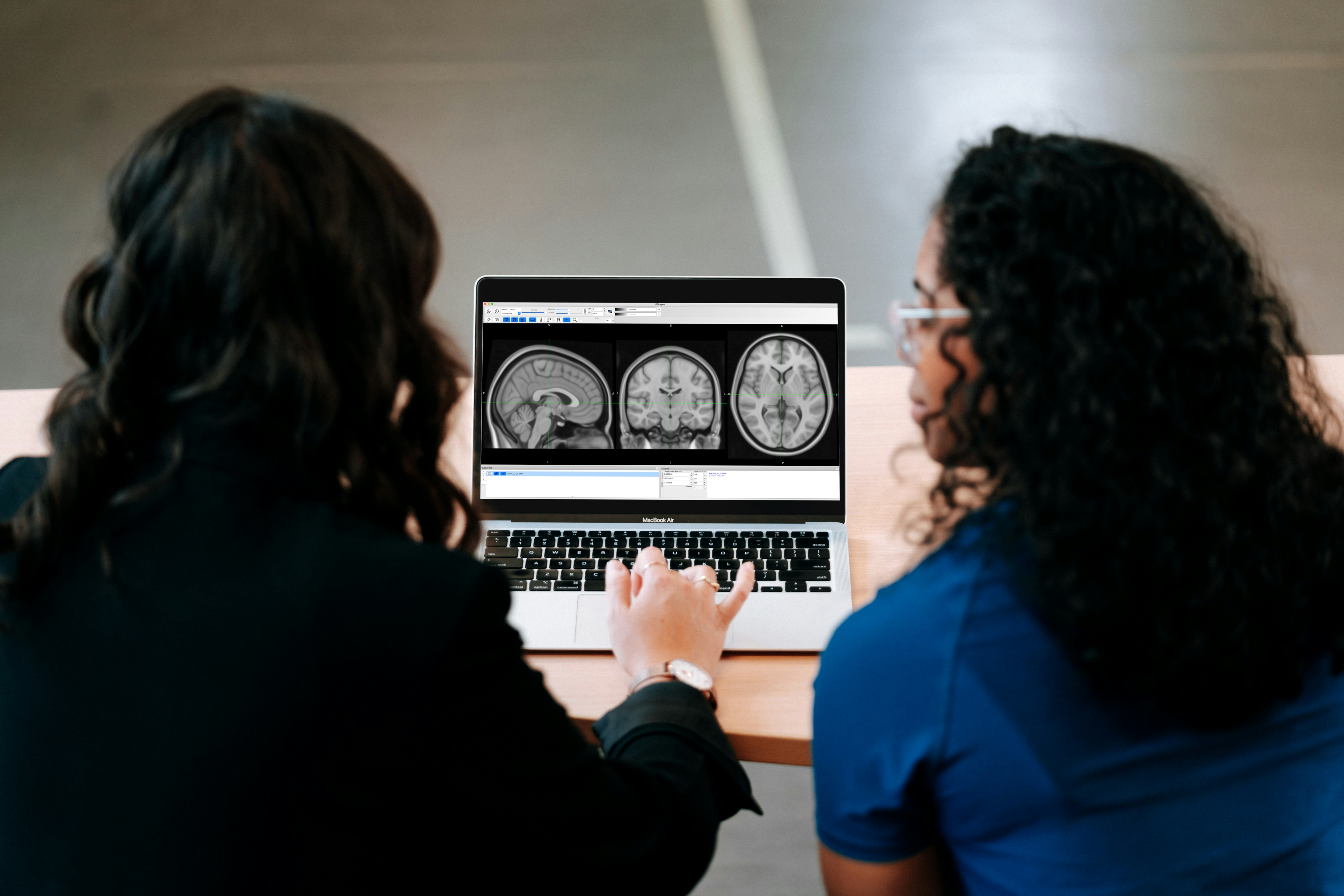 Up to 85 Percent of People with Uncommon Forms of Alzheimer's Would Not Qualify for the New Drugs, Study Finds