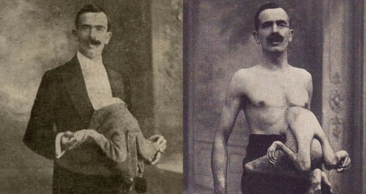 The Life Of Circus Performer Jean Libbera, The Man With A Parasitic Twin Growing Out Of His Torso
