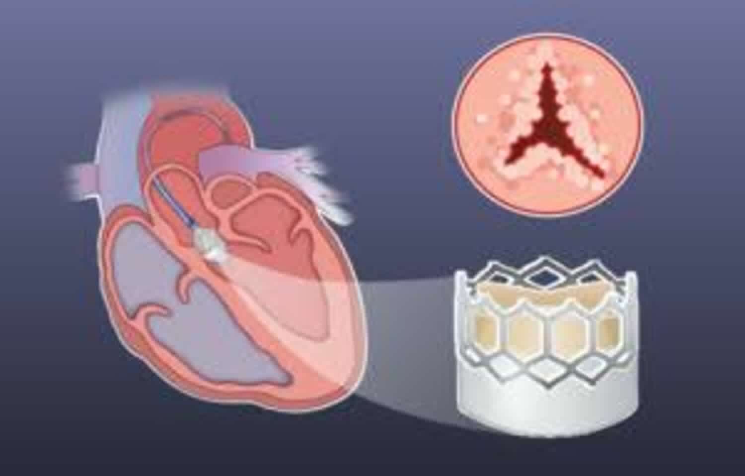 Exercise Testing may  Help identify patients needing prompt treatment in
Asymptomatic Severe AS: JAMA
