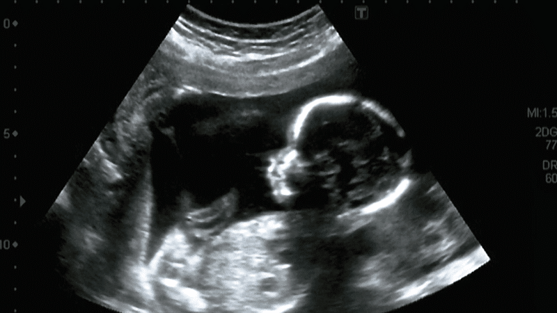 Pro-abortion MP rejects 'extreme' proposal over risks to women