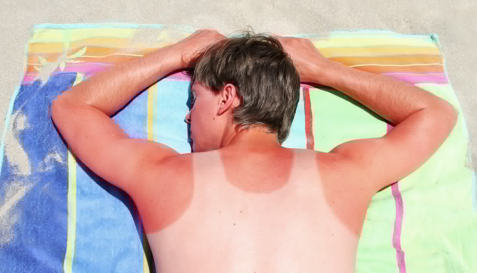 How 1 sunburn can be ‘life-changing’