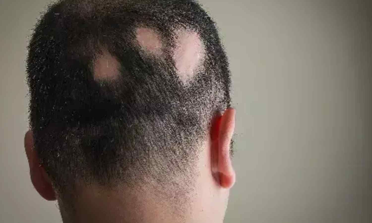 Alopecia Areata Associated With Increased Risk of Retinal Abnormalities: Study