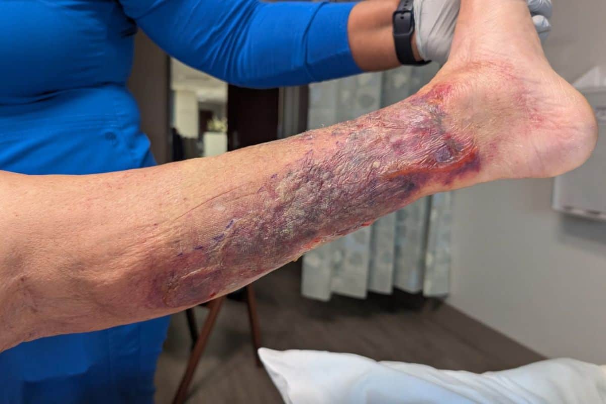 Vibrio Vulnificus ‘Flesh-Eating’ Cases Rising in Florida in New Update