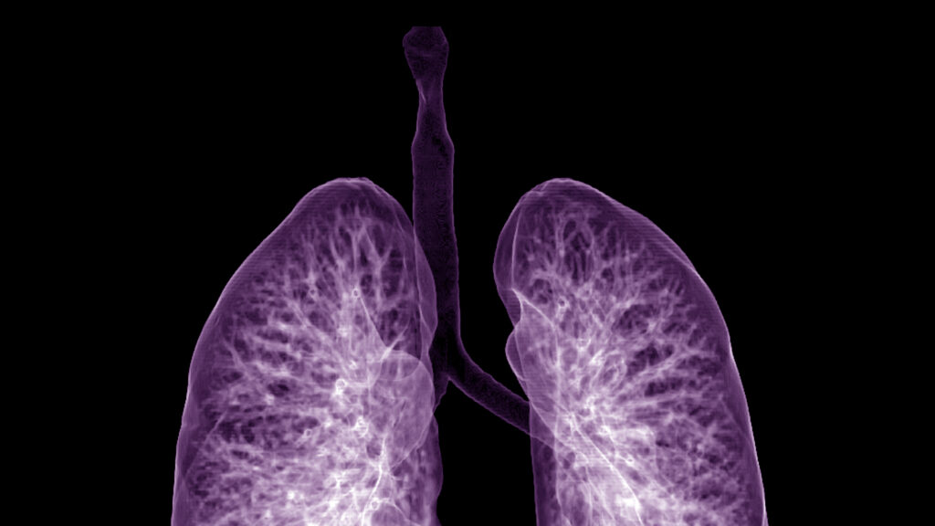 STAT+: Sionna’s experimental cystic fibrosis pill falls flat in mid-stage trial