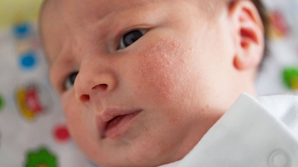 How to spot and treat heat rash in babies and children