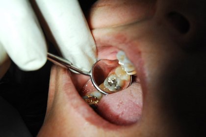 If mercury is too dangerous for Alabama rivers, why is it still in our mouths?: op-ed