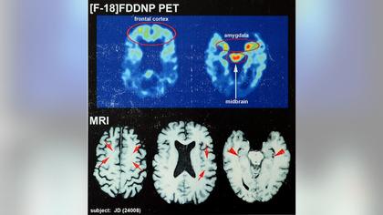 Study reveals pre-CTE damage in brains of even young contact-sport athletes