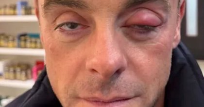 ITV's Ant McPartlin's eye 'blows up' as he says 'you can see it's bad'