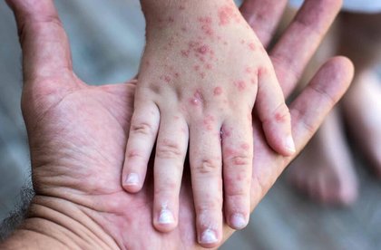 Qué hacer tras detectar el sarampión: Guía para frenar el contagio
