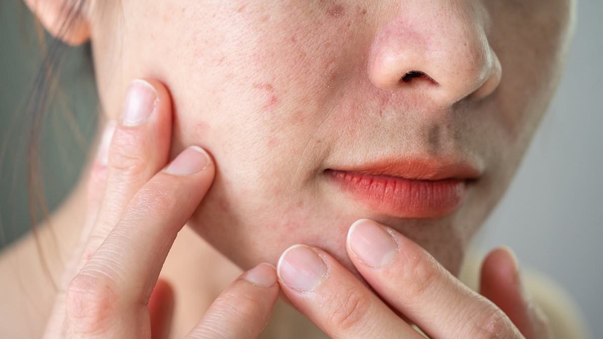 The daily routine and diet that could transform psoriasis-prone skin in just six weeks... and the 'healthy' daily drink that could be your worst enemy