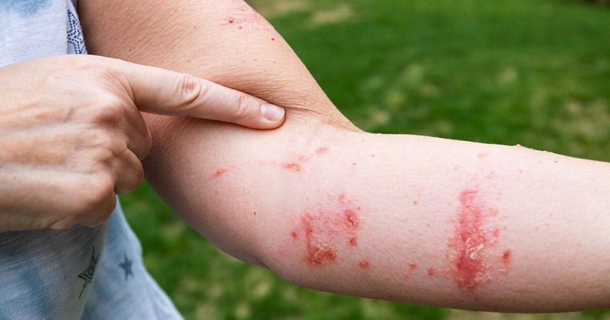 6 ways to get rid of poison ivy rash symptoms fast