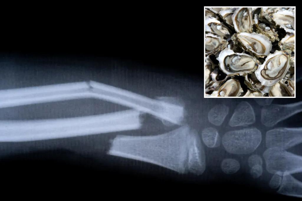 Chinese-made ‘bone glue’ fixes fractures in just 3 minutes with one injection: report