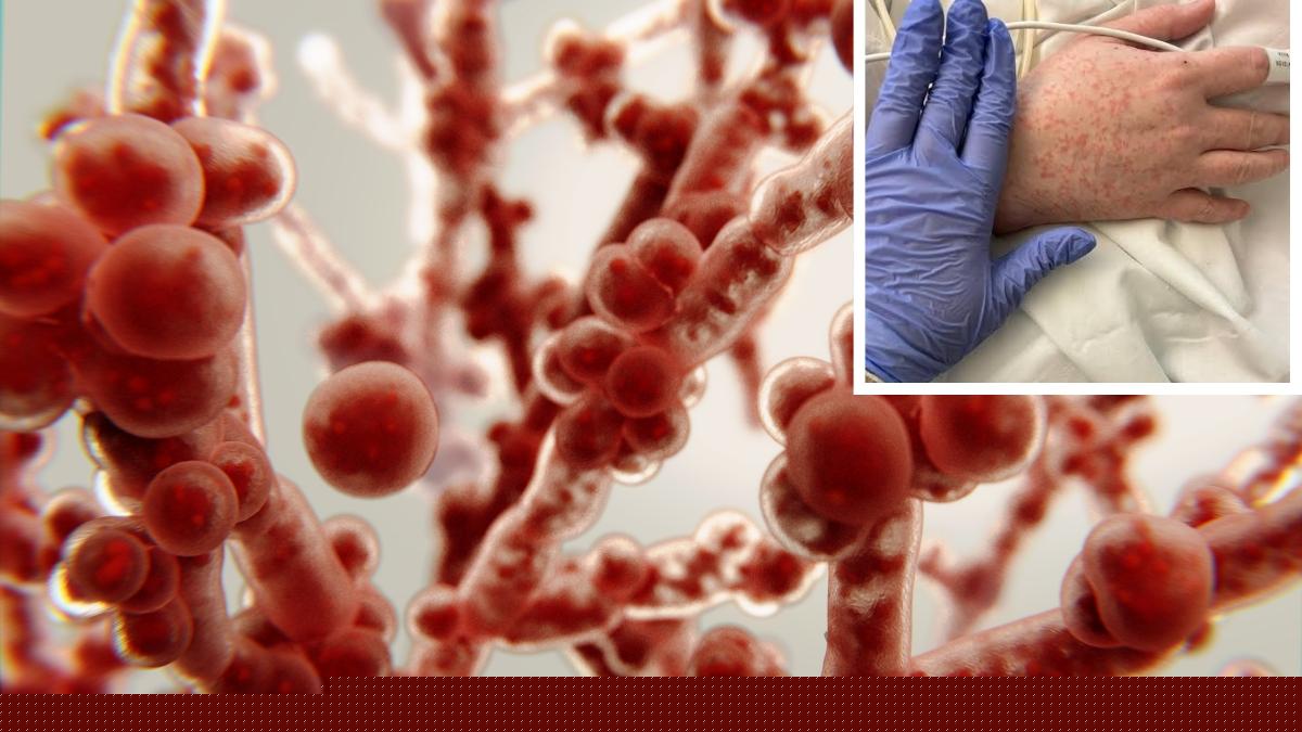 Candida auris outbreak in US: Causes, symptoms, spread and treatment explained