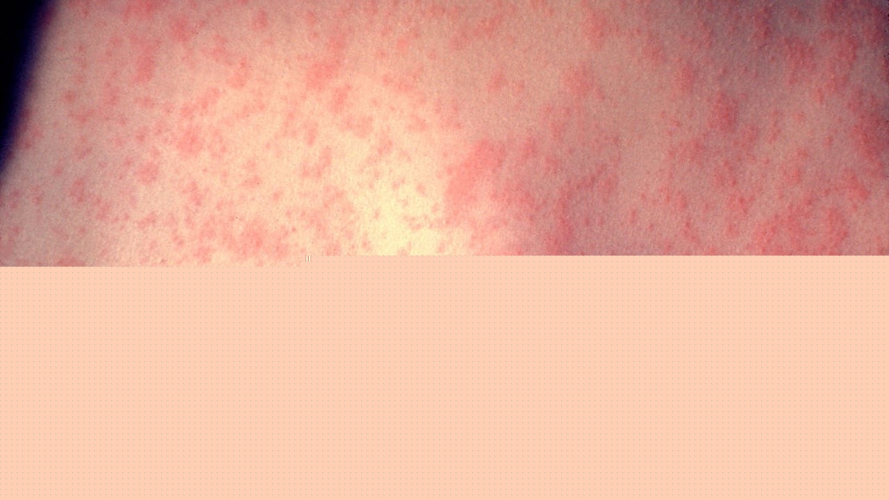 Measles cases hit highest level in decades, CDC says
