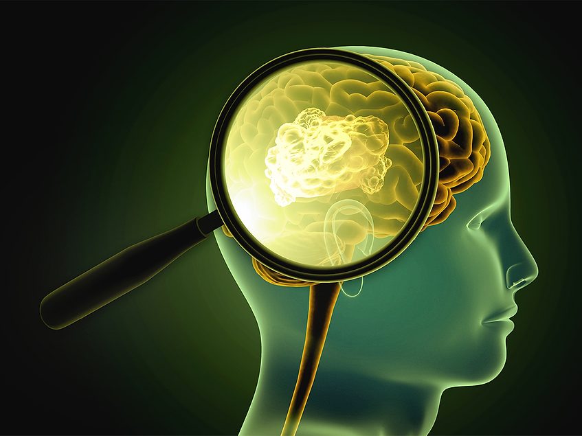 Cancer neuroscience is testing repurposing of neuroactive drugs to treat tumors