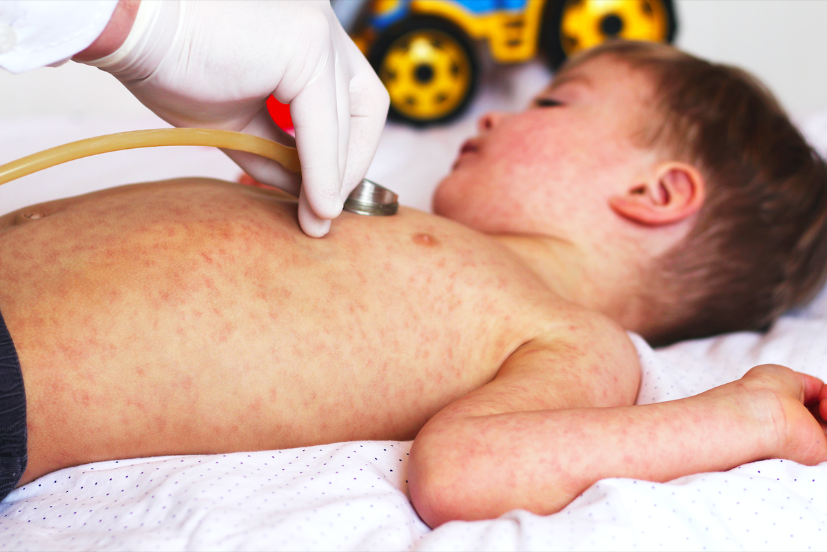 Comment on WHO Confirms Loss of Measles Elimination Status in Spain and UK by Lee