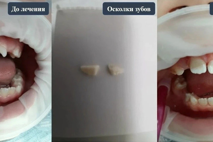 В Воронеже стоматологи вернули 7-летнему «родную» улыбку после травмы на самокате