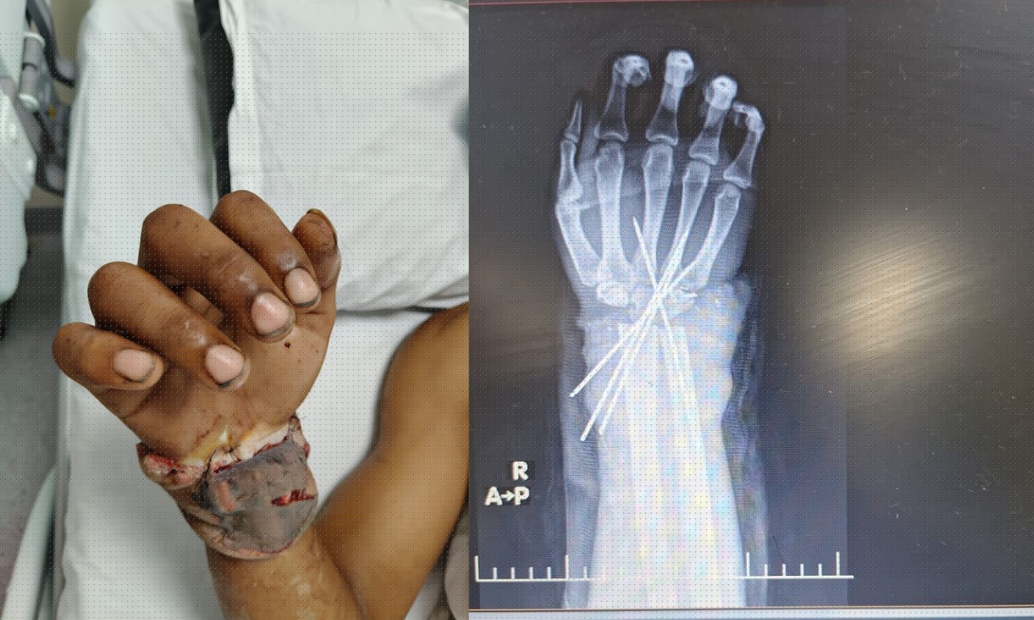 18-Year-Old Gets Hand Replanted After Complete Amputation in Construction-Site Accident