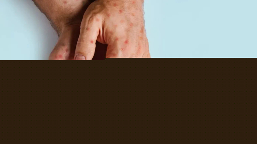 SHBA regjistron nivelin më të lartë të rasteve të fruthit në 35 vjet, mbi 2,300 të infektuar