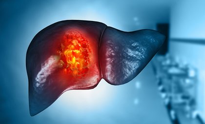 Semaglutide Reduces Liver Fibrosis and Resolves MASH