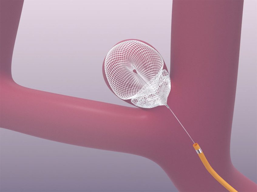 Galaxy receives CE mark for brain aneurysm system
