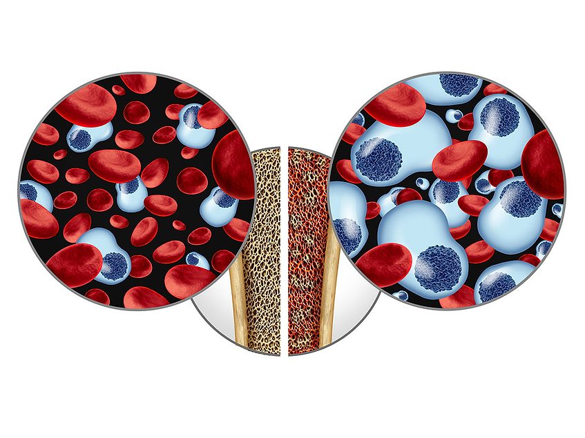 FDA clears IND for Brightpath’s BP-2202 for multiple myeloma