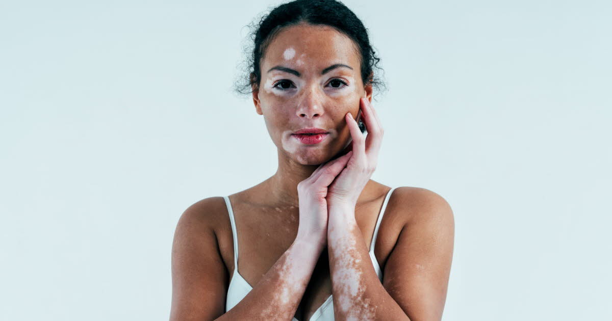 Santé. Vitiligo : c'est quoi cette maladie de la peau dont souffrait notamment Michael Jackson ?