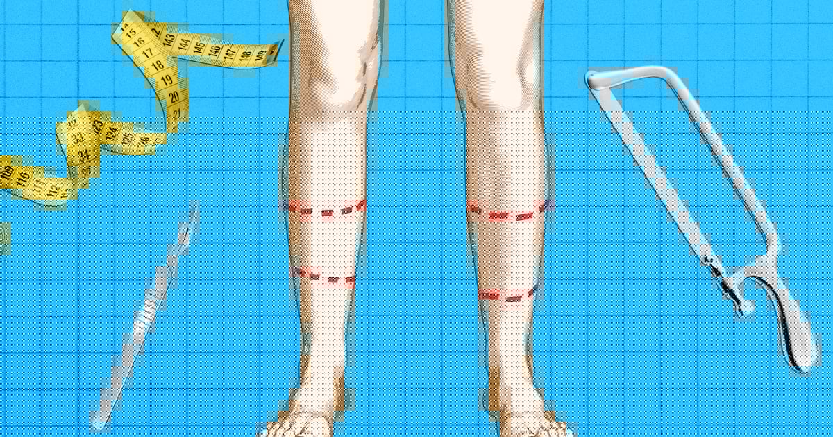 Why Leg-Lengthening Surgeries for Men May Soon Go Mainstream