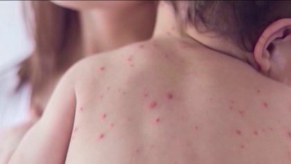 Health officials report new measles exposure in Mesa