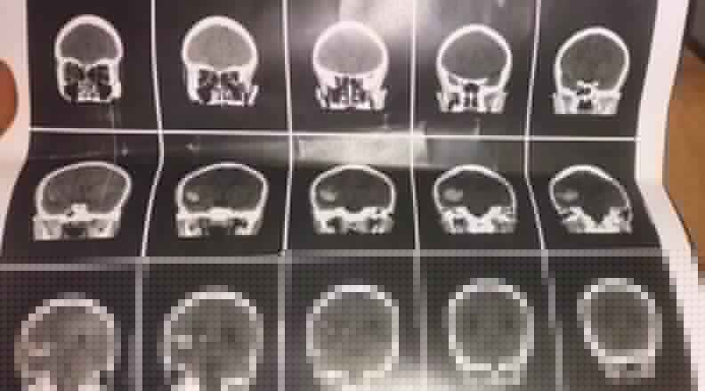 Estudante de 13 anos é internado na UTI com hemorragia cerebral após agressão com pá em escola cívico-militar de Birigui