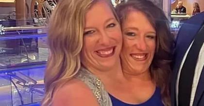 What Happens When One Conjoined Twin Dies? Here’s What Science Says