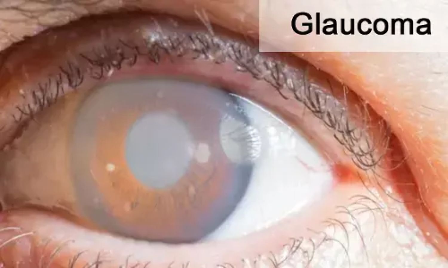 Sleeping without pillows may lower harmful high IOP in people with glaucoma, suggests study