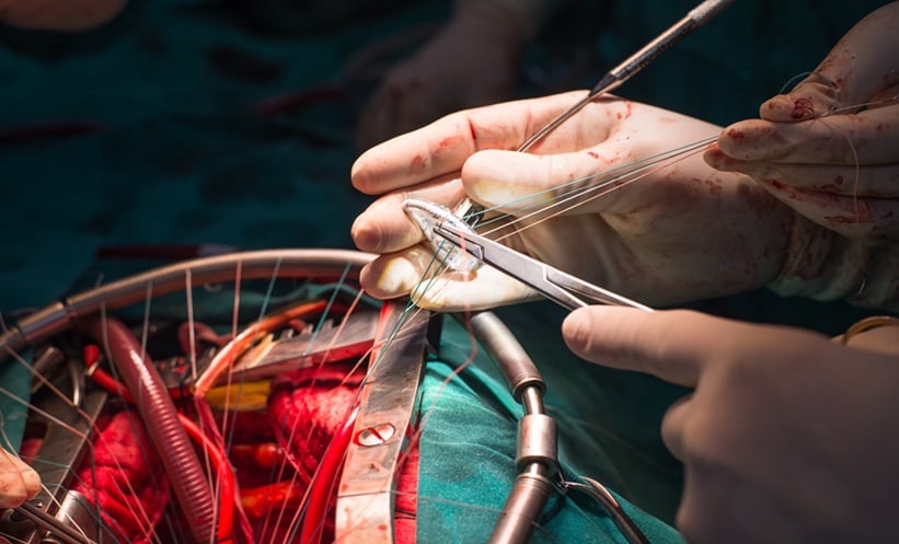 Surgery Improved Outcomes in Moderate Mitral Regurgitation