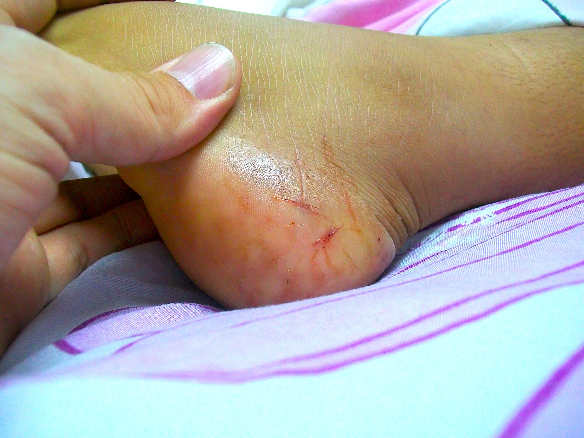 Nurse Bitten By Snake At Health Sub-Centre In Palakkad