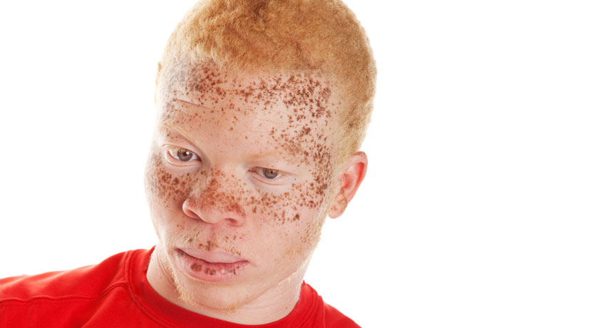 Comment on Cancer proposed as spur for evolution of dark-skinned ancestors by URL
