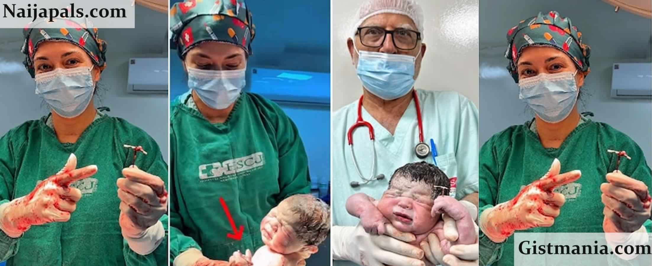 Newborn Goes Viral After Being Born Holding Mother’s Failed Contraceptive Coil