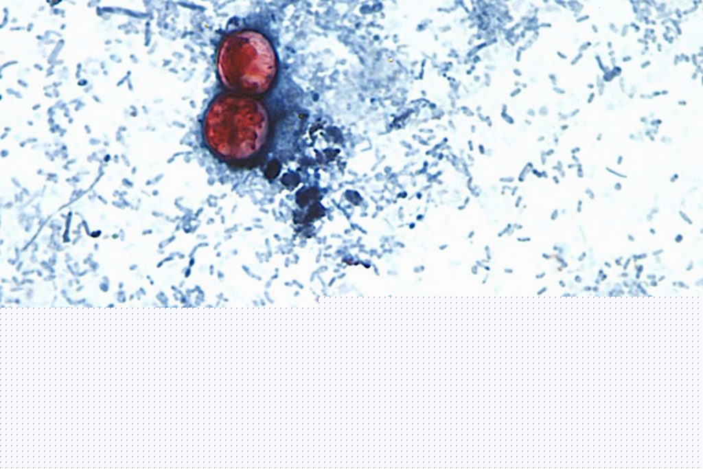 DOH Confirms Fourth Case of Cyclosporiasis