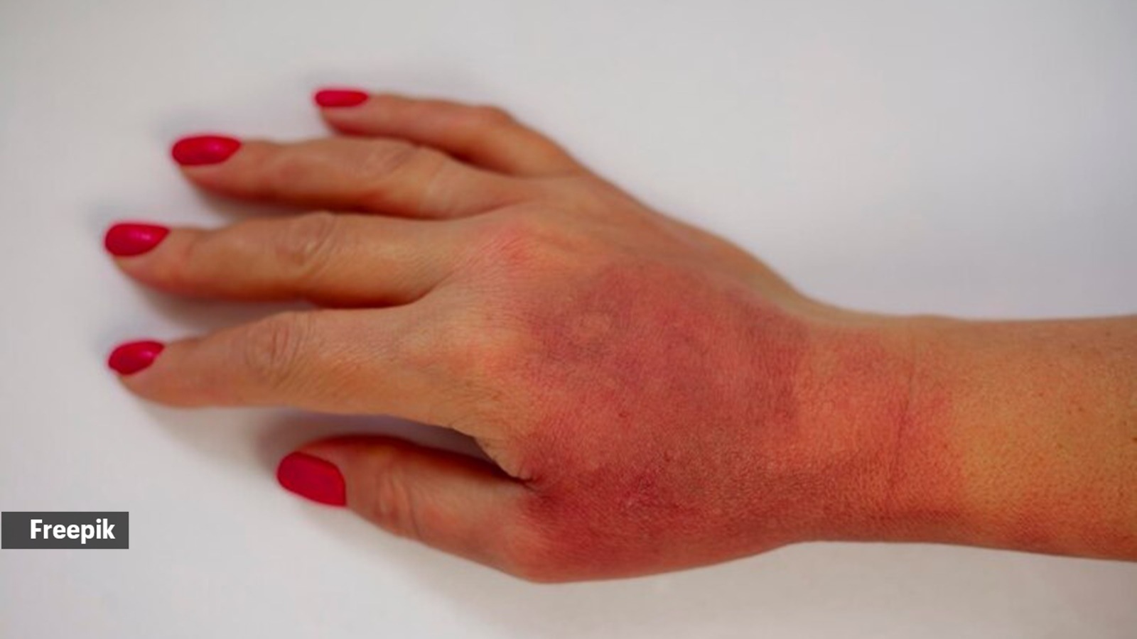 Why this common burn remedy is actually dangerous