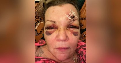 'Battered' gran, 57, left looking like this after Hanley night out