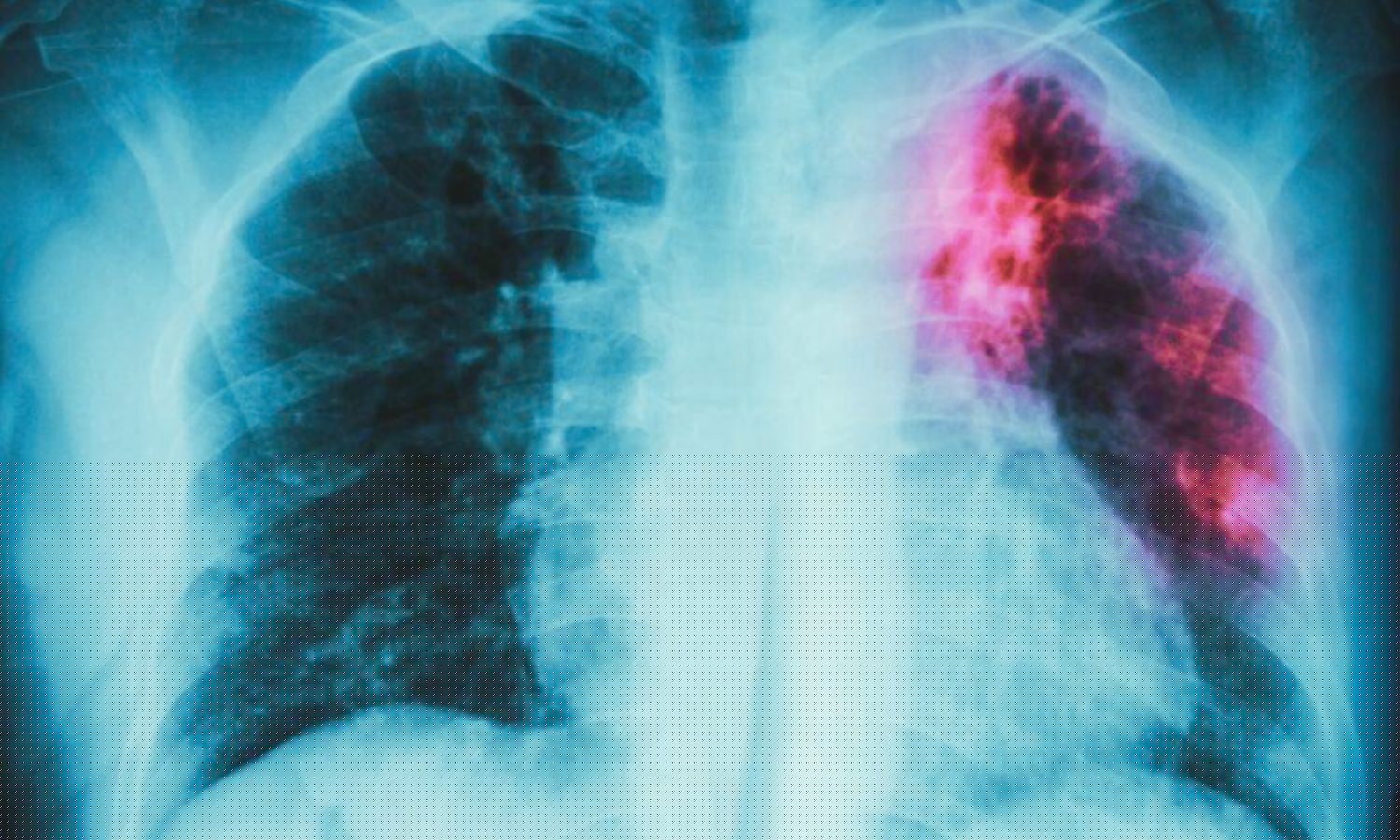 Nine in Ten Rural Older Adults Have Major TB Risk Factors, Finds Study