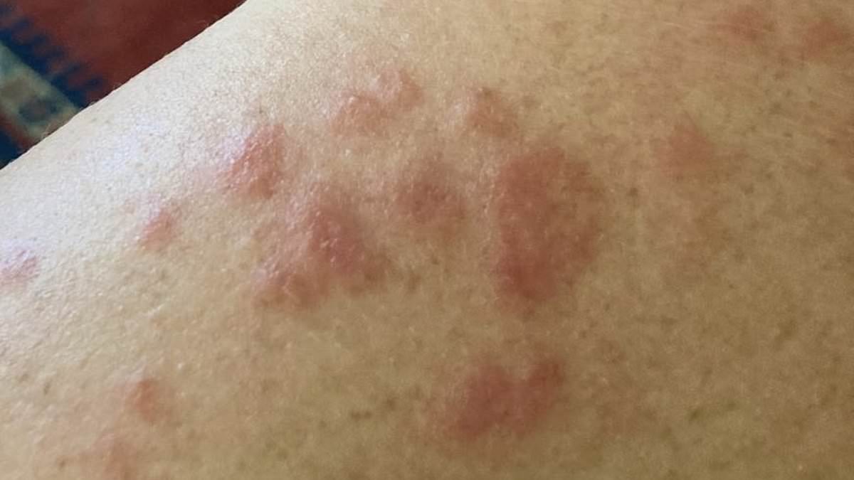 For more than 30 years experts dismissed my angry red hives as rosacea. In fact, I have an autoimmune condition that affects thousands of menopausal women but is often misdiagnosed. These are the other symptoms to look out for