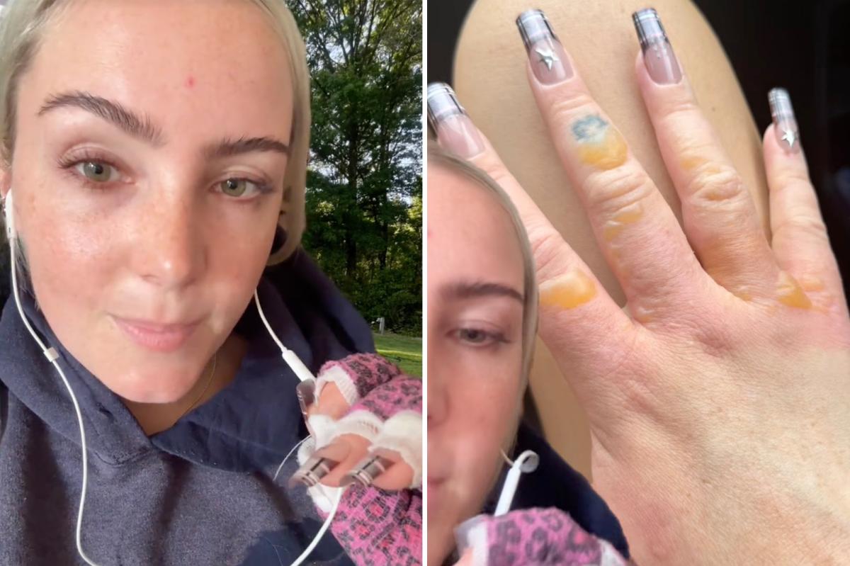 NYC woman warns against getting painful, blistering  ‘Margarita Burn’ by avoiding this common summer activity