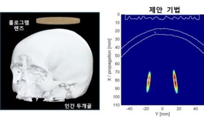 AI-based hologram technology to advance multi-focal brain stimulation