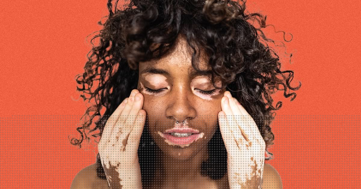 What It’s Really Like To Get A Vitiligo Diagnosis — At Every Age
