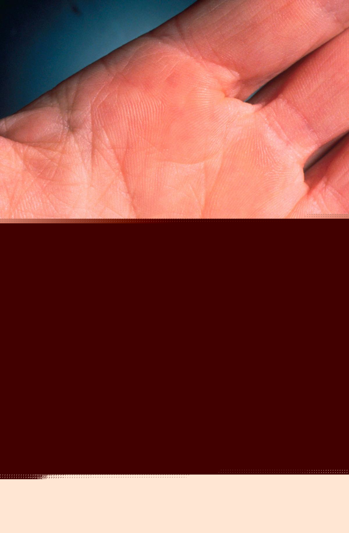 Upstate New York Man Shocked By 20 Deadly Ticks